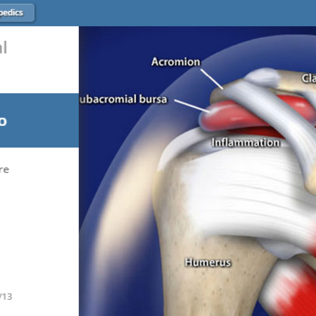 Subdeltoid Bursitis Shoulder