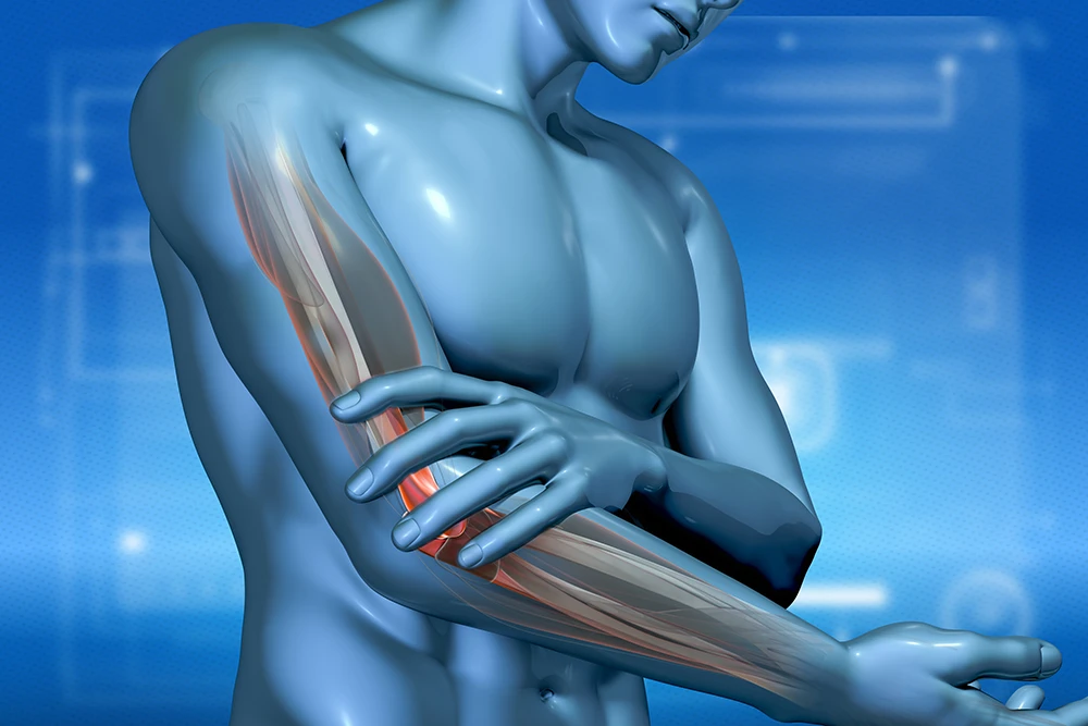 Tennis Elbow Surgery: Medical illustration highlighting inflamed elbow tendons and forearm muscles